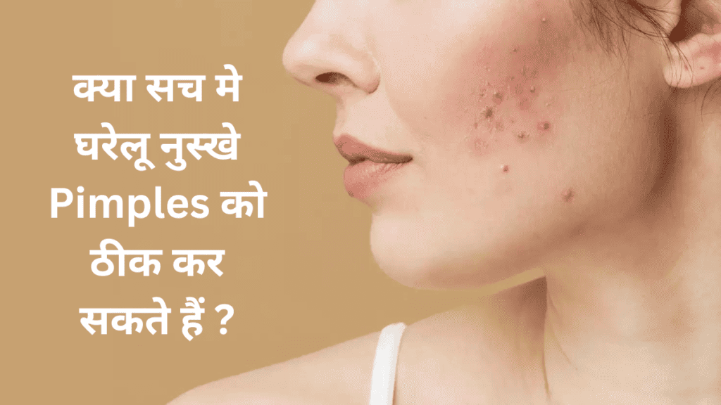 क्या सच मे HOMEMADE फ़ेस मास्क PIMPLE या दूसरी परेशानियों को ठीक करते हैं ?