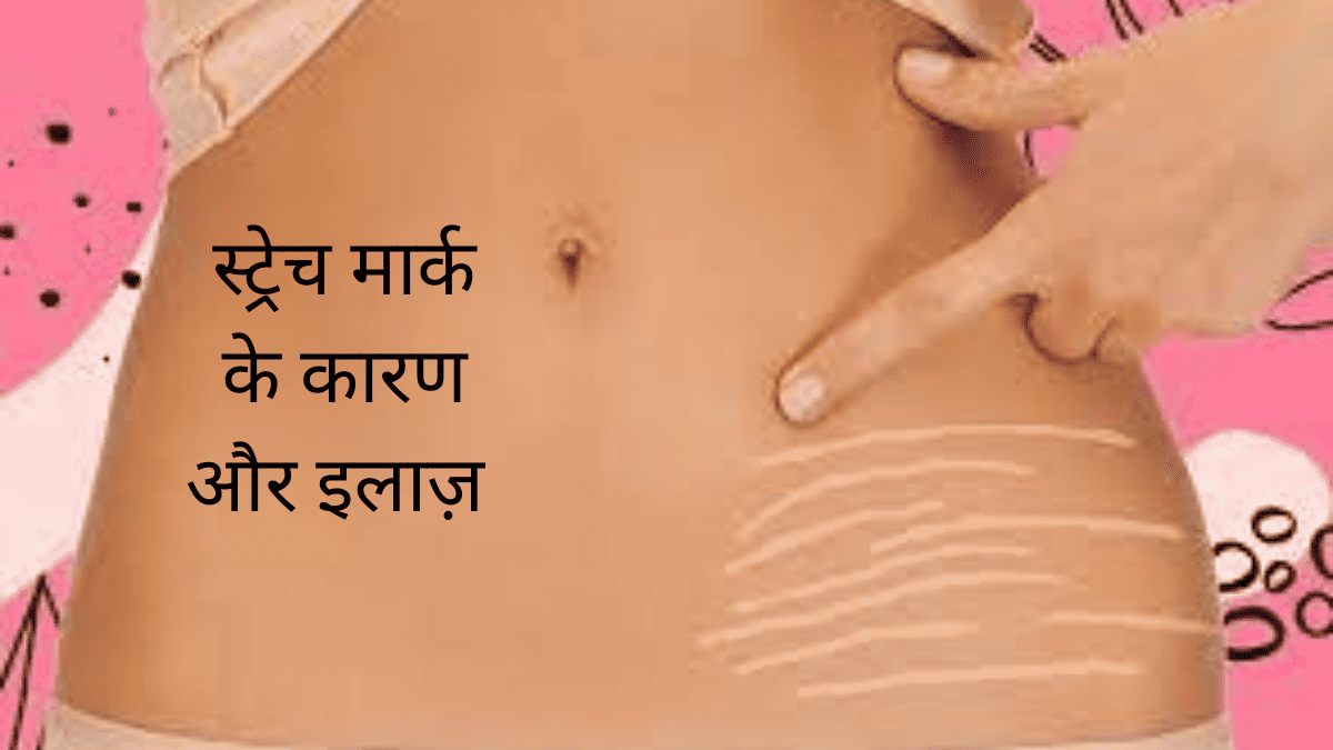 ये हैं stretch मार्क के 6 कारण और इलाज